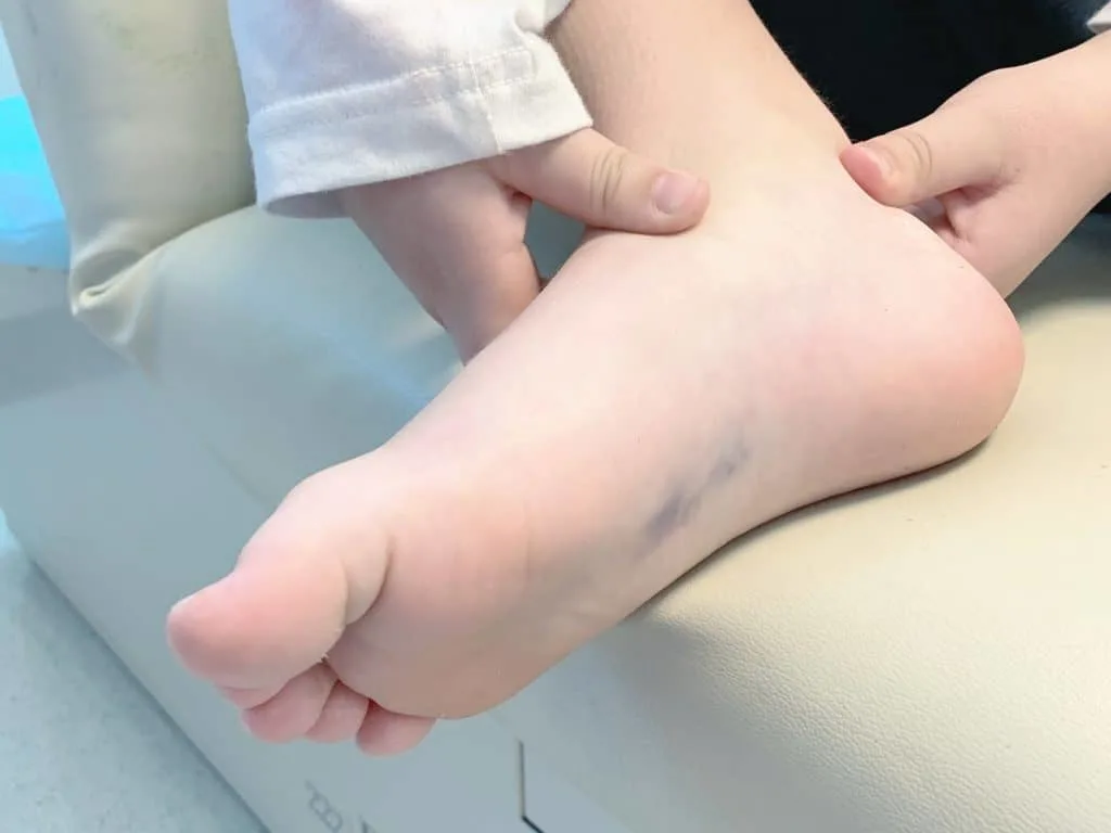 broken foot cast removal