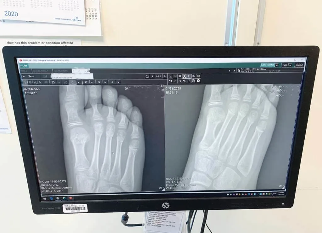Broken foot xray comparison