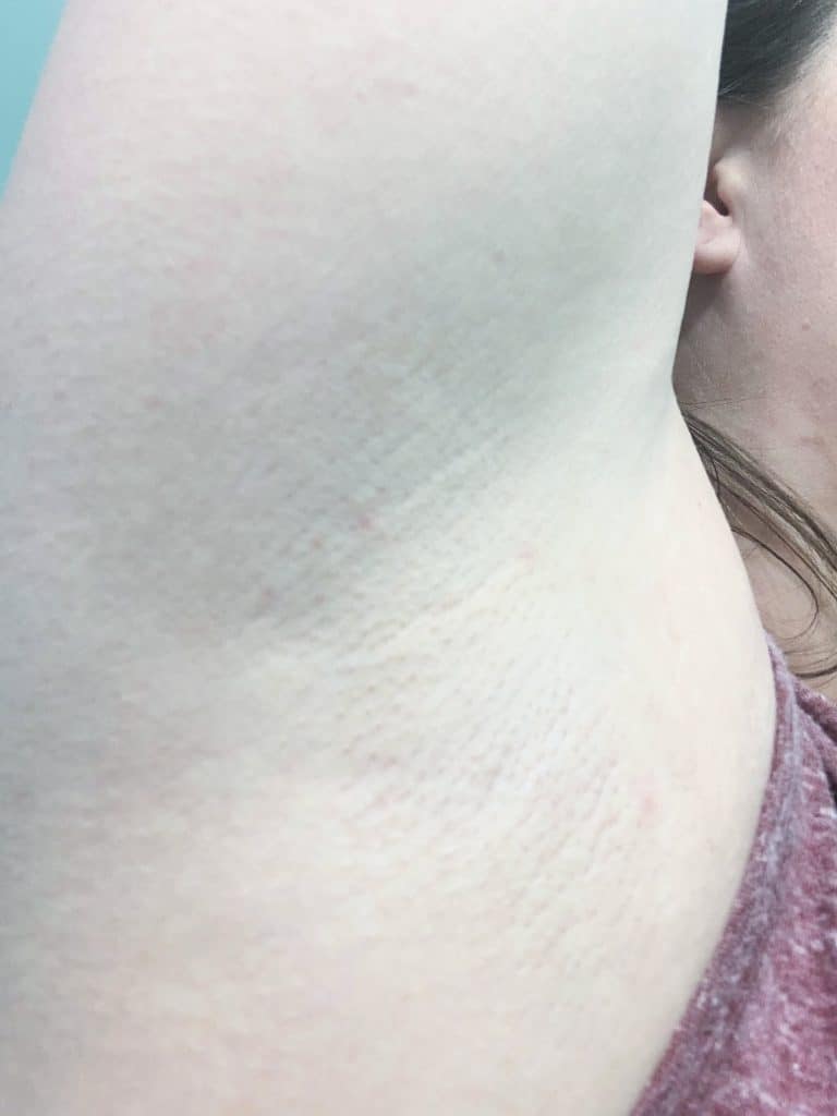 Armpit laser hair removal results